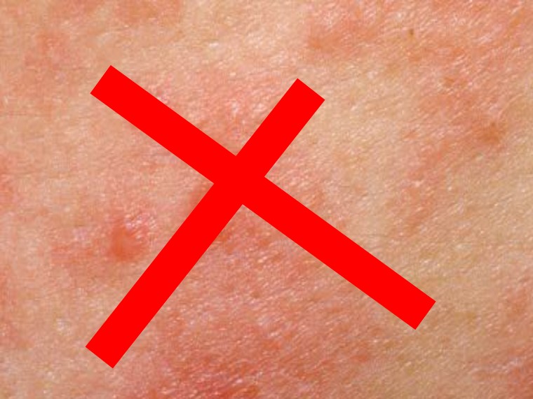 Eczema Outbreaks