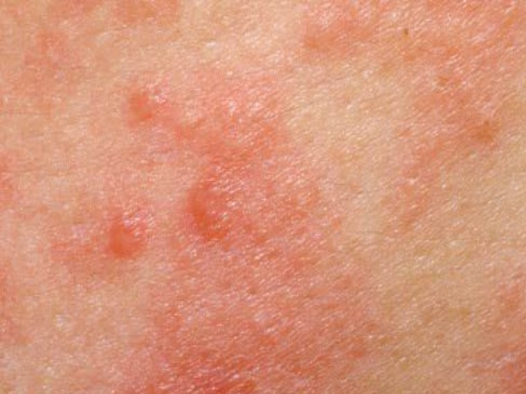 Eczema with Home Remedies