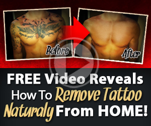 Tattoo Removal Before After Photo