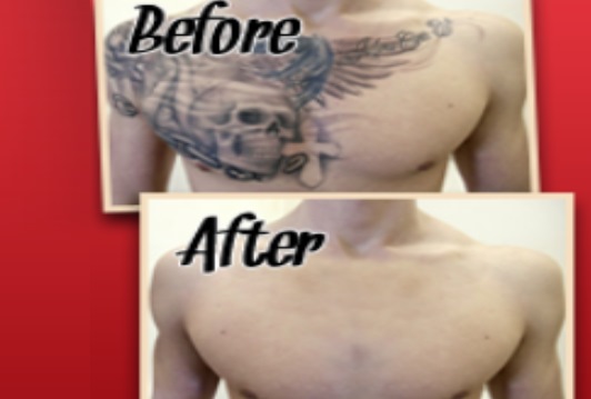 Tattoo Removal Before and After Photo